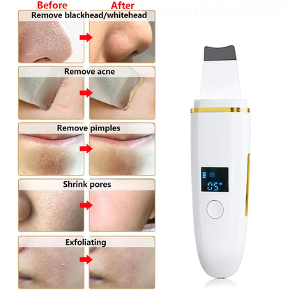 Ultrasonic Skin Scrubber: Facial Cleansing - Eloy Royal